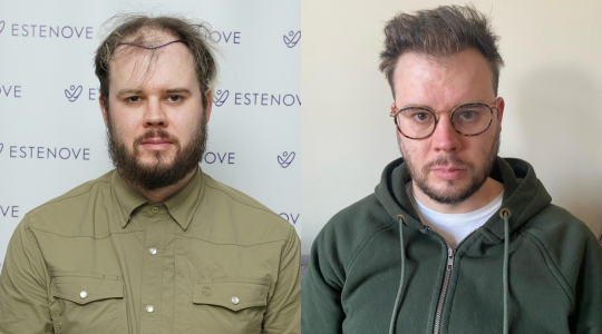 پیوند مو در ترکیه: تجربه‌ای شخصی و عمیق از کاشت مو