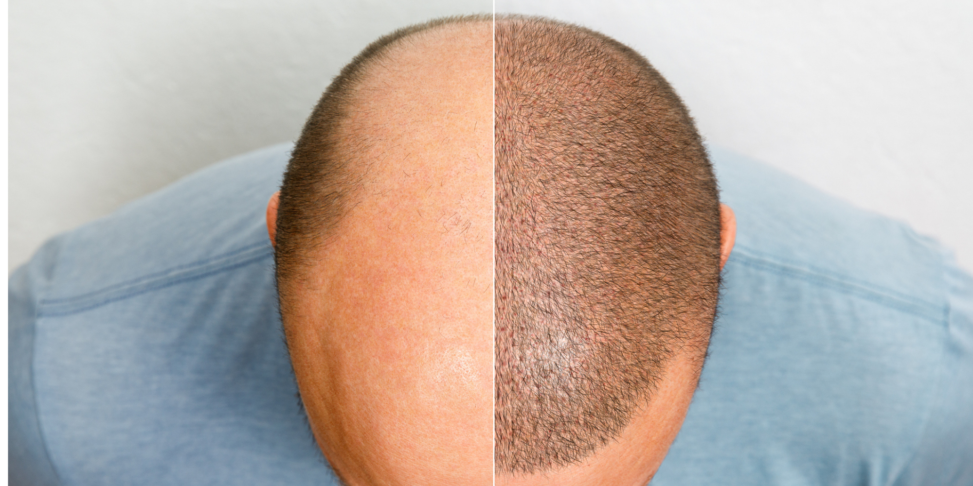 پیوند مو در ترکیه: تجربه‌ای شخصی و عمیق از کاشت مو