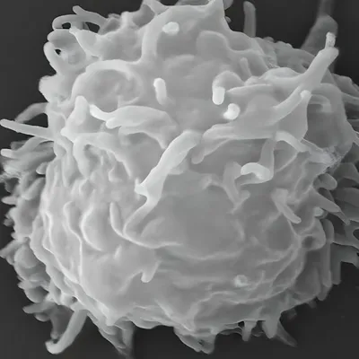 Rare Acanthamoeba Infection Manifests with Unusual Skin Lesions