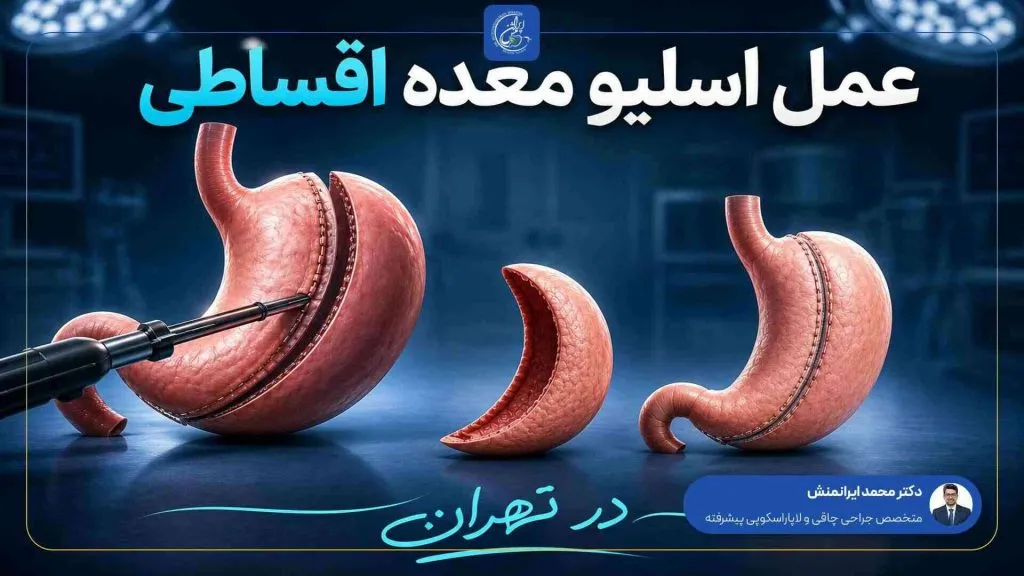 عمل اسلیو معده اقساطی