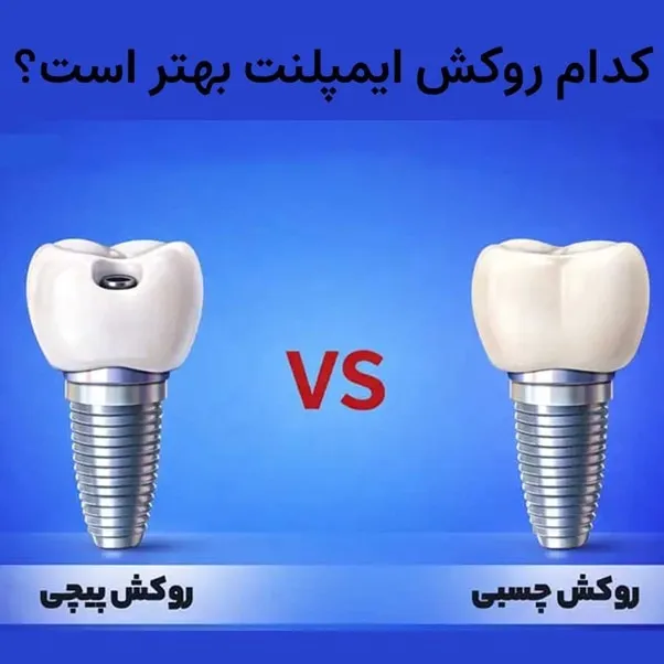 کدام روکش ایمپلنت بهتر است، پیچی یا چسبی؟