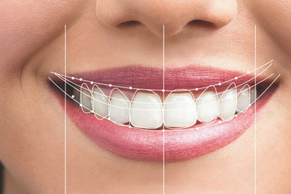 خداحافظی با خمیر دندانپزشکی؛ چرا طراحی لبخند دیجیتال (DSD) جایگزین روش‌های سنتی شد؟